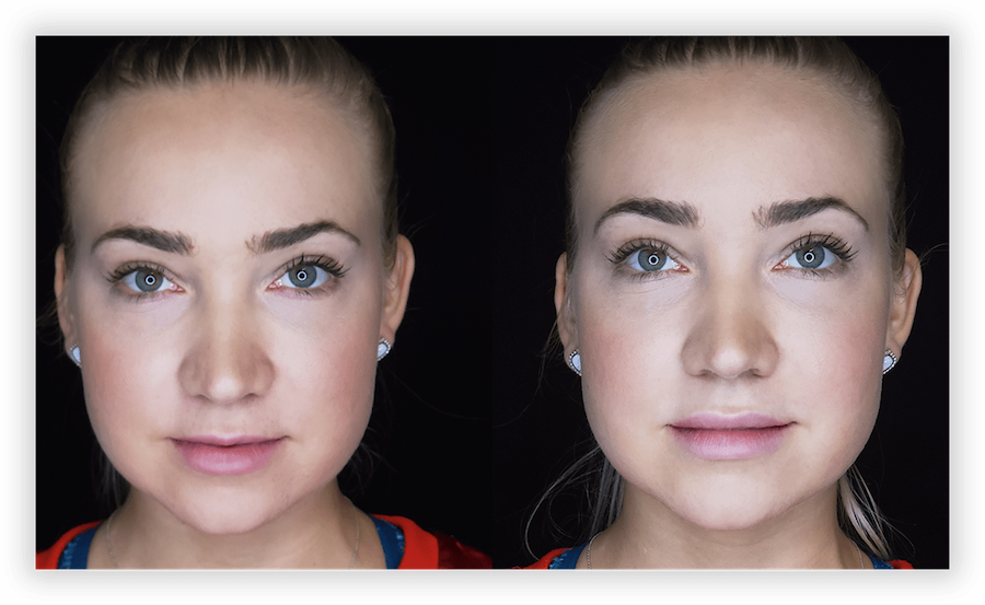 Non Surgical Facelift 1